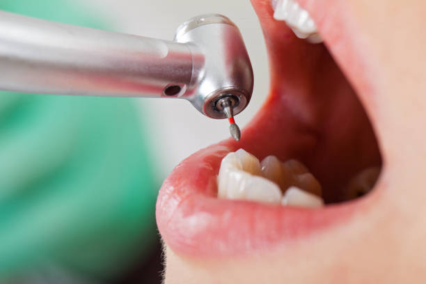 Best Emergency Dentist for Lost Fillings or Crowns in Kewanee, IL